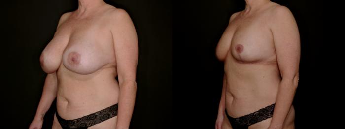 Before & After Breast Lift (Breast Mastopexy - No Implants) Case 761 Left Oblique View in Fort Worth & Arlington, Texas