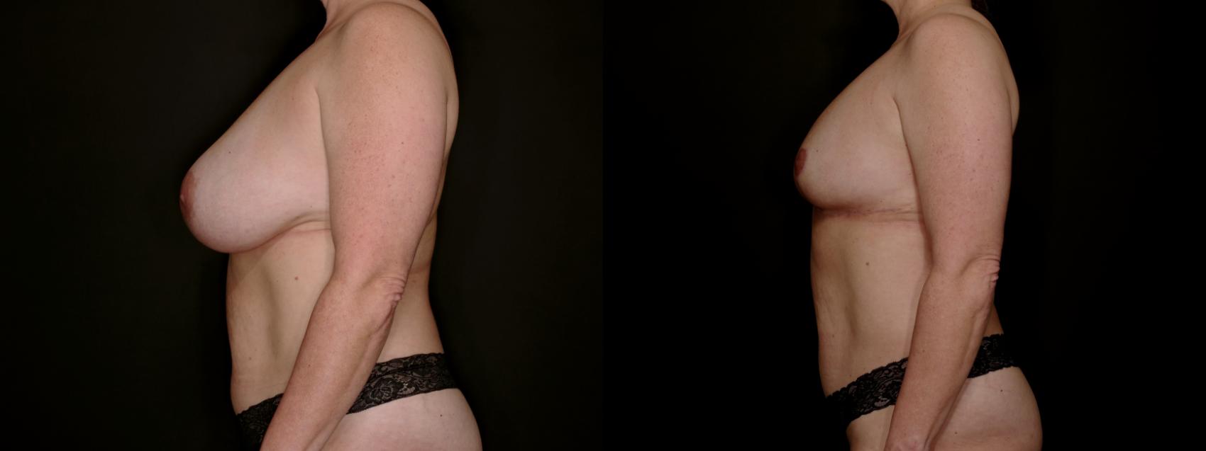 Before & After Breast Lift (Breast Mastopexy - No Implants) Case 761 Left Side View in Fort Worth & Arlington, Texas