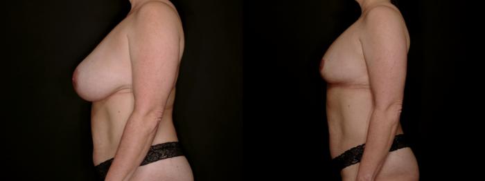Before & After Breast Lift (Breast Mastopexy - No Implants) Case 761 Left Side View in Fort Worth & Arlington, Texas