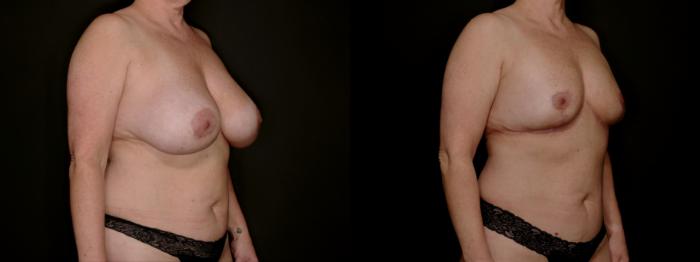 Before & After Breast Lift (Breast Mastopexy - No Implants) Case 761 Right Oblique View in Fort Worth & Arlington, Texas