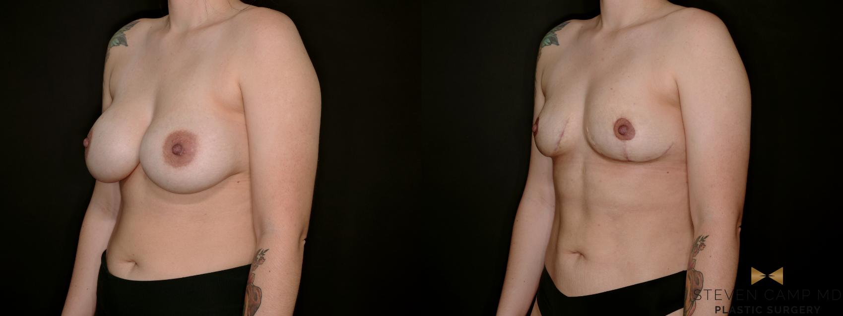 Before & After Breast Implant Explantation Case 767 Left Oblique View in Fort Worth & Arlington, Texas