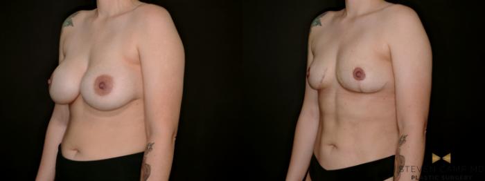 Before & After Breast Implant Explantation Case 767 Left Oblique View in Fort Worth & Arlington, Texas