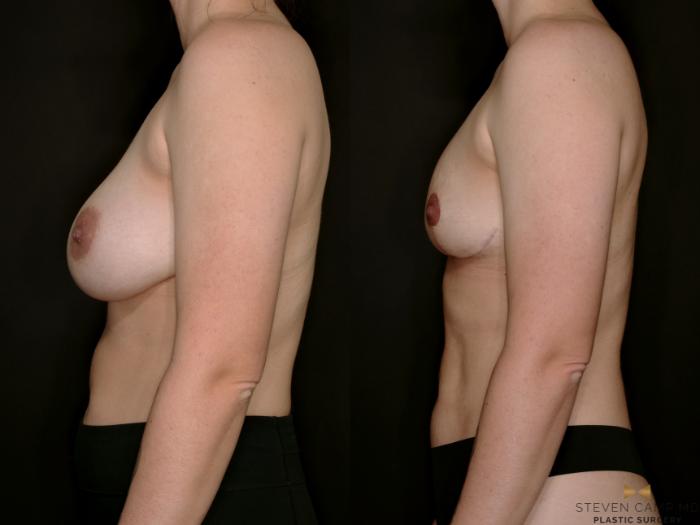 Before & After Breast Implant Explantation Case 767 Left Side View in Fort Worth & Arlington, Texas