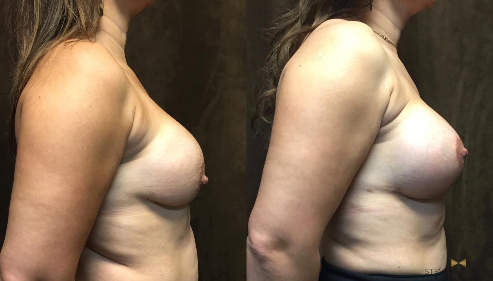 Before & After Breast Implant Explantation Case 77 View #3 View in Fort Worth & Arlington, Texas
