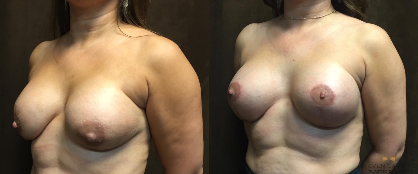 Before & After Breast Implant Explantation Case 77 View #4 View in Fort Worth & Arlington, Texas