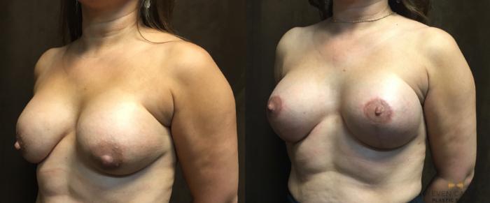 Before & After Breast Lift with or without Implants Case 77 View #4 View in Fort Worth, Texas