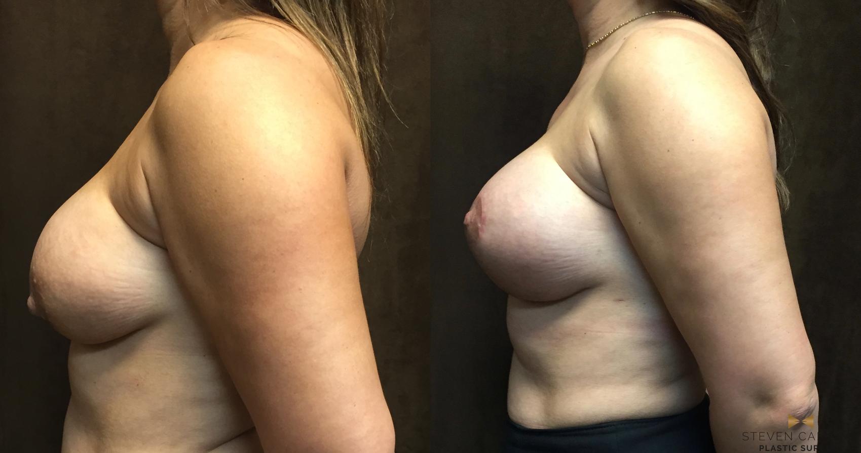 Before & After Breast Implant Explantation Case 77 View #5 View in Fort Worth & Arlington, Texas