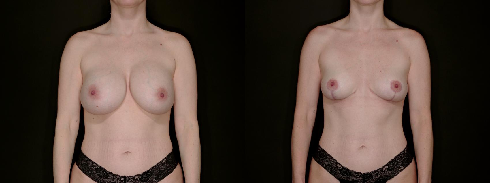 Before & After Breast Implant Explantation Case 793 Front View in Fort Worth & Arlington, Texas