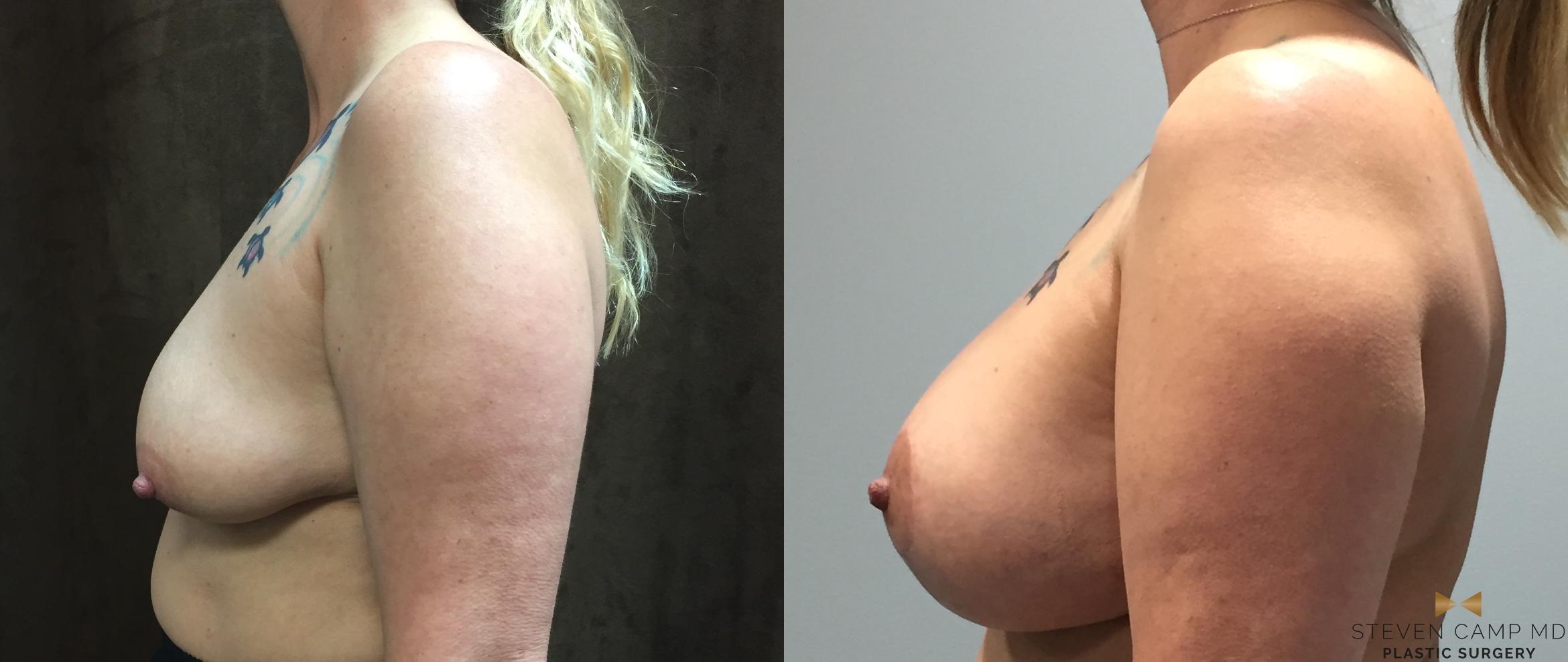 Breast Lift with or without Implants Before & After Photo | Fort Worth, Texas | Steven Camp MD Plastic Surgery