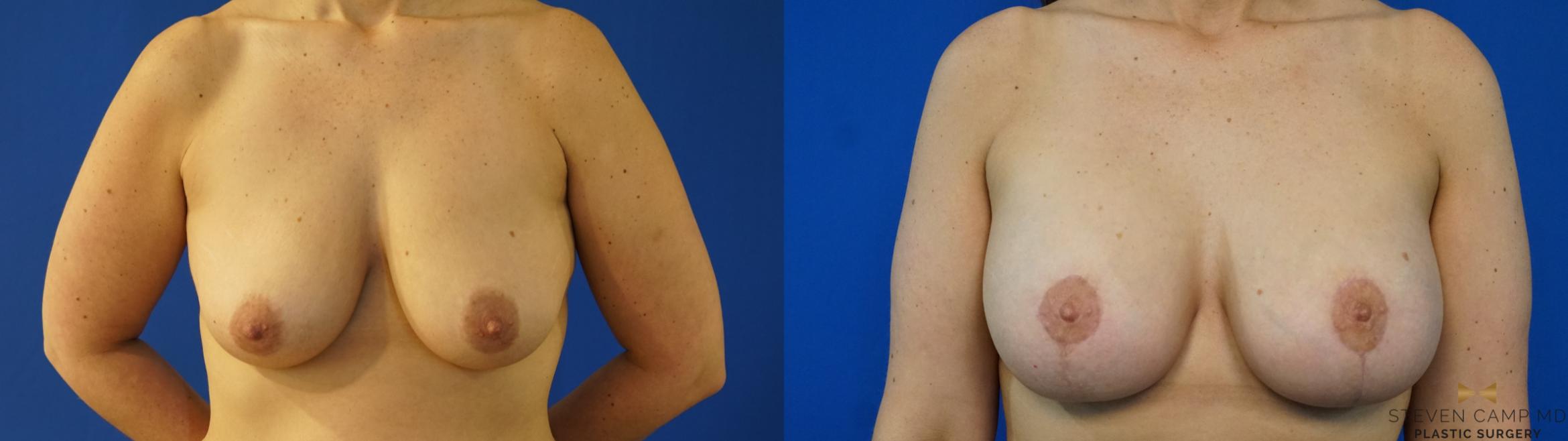 Breast Lift with or without Implants Before & After Photo | Fort Worth, Texas | Steven Camp MD Plastic Surgery
