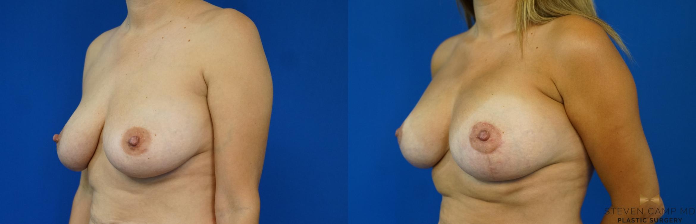 Before & After Breast Lift with or without Implants Case 169 View #1 View in Fort Worth, Texas