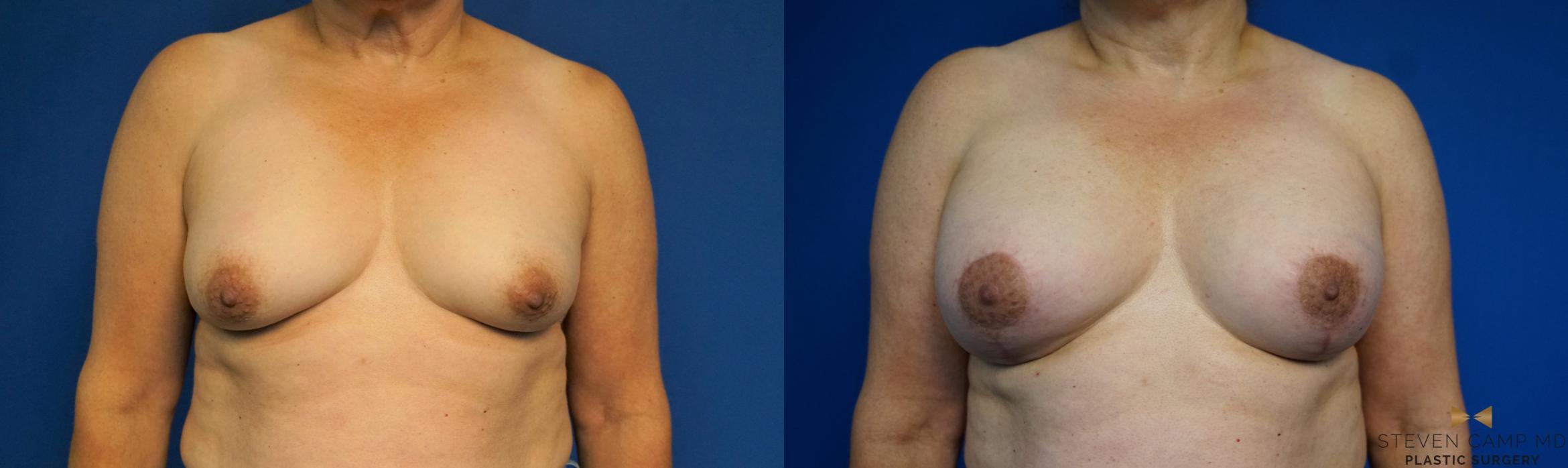 Before & After Breast Lift with or without Implants Case 212 View #1 View in Fort Worth, Texas