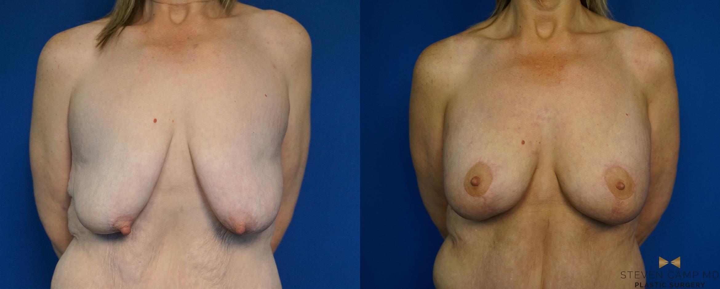 Before & After Breast Lift with or without Implants Case 214 View #1 View in Fort Worth, Texas