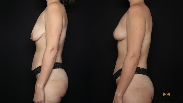 Before & After Breast Lift (Breast Mastopexy - No Implants) Case 758 Left Side View in Fort Worth & Arlington, Texas