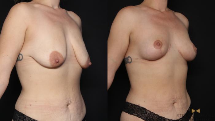Before & After Breast Lift (Breast Mastopexy - No Implants) Case 758 Right Oblique View in Fort Worth & Arlington, Texas