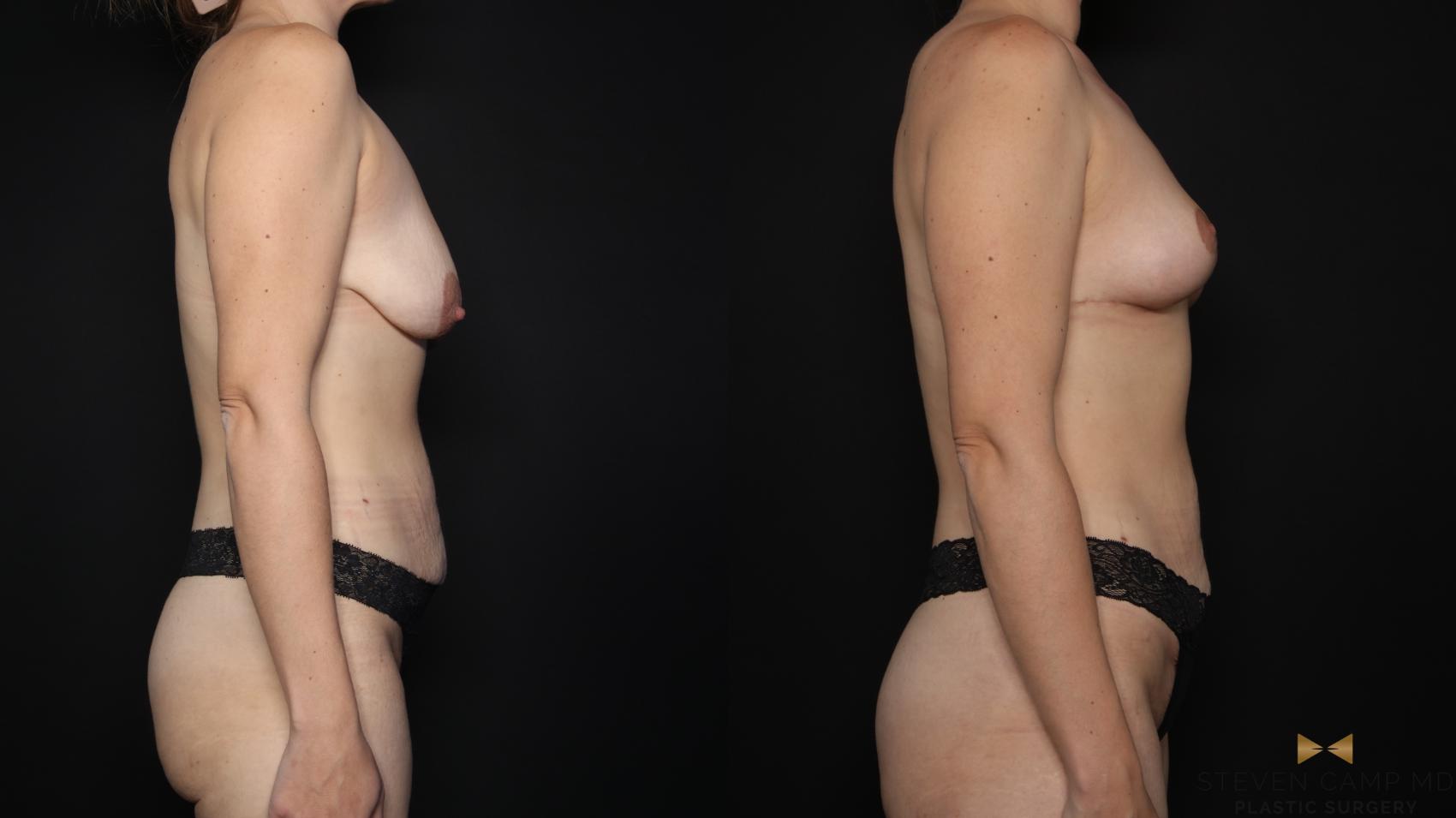 Before & After Breast Lift (Breast Mastopexy - No Implants) Case 758 Right Side View in Fort Worth & Arlington, Texas