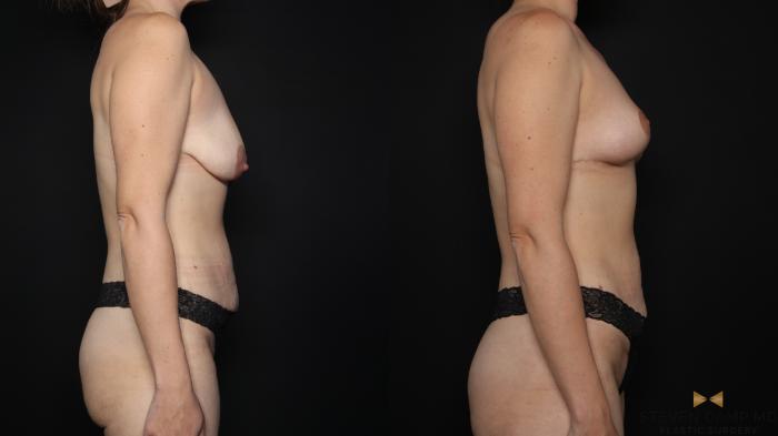 Before & After Breast Lift (Breast Mastopexy - No Implants) Case 758 Right Side View in Fort Worth & Arlington, Texas