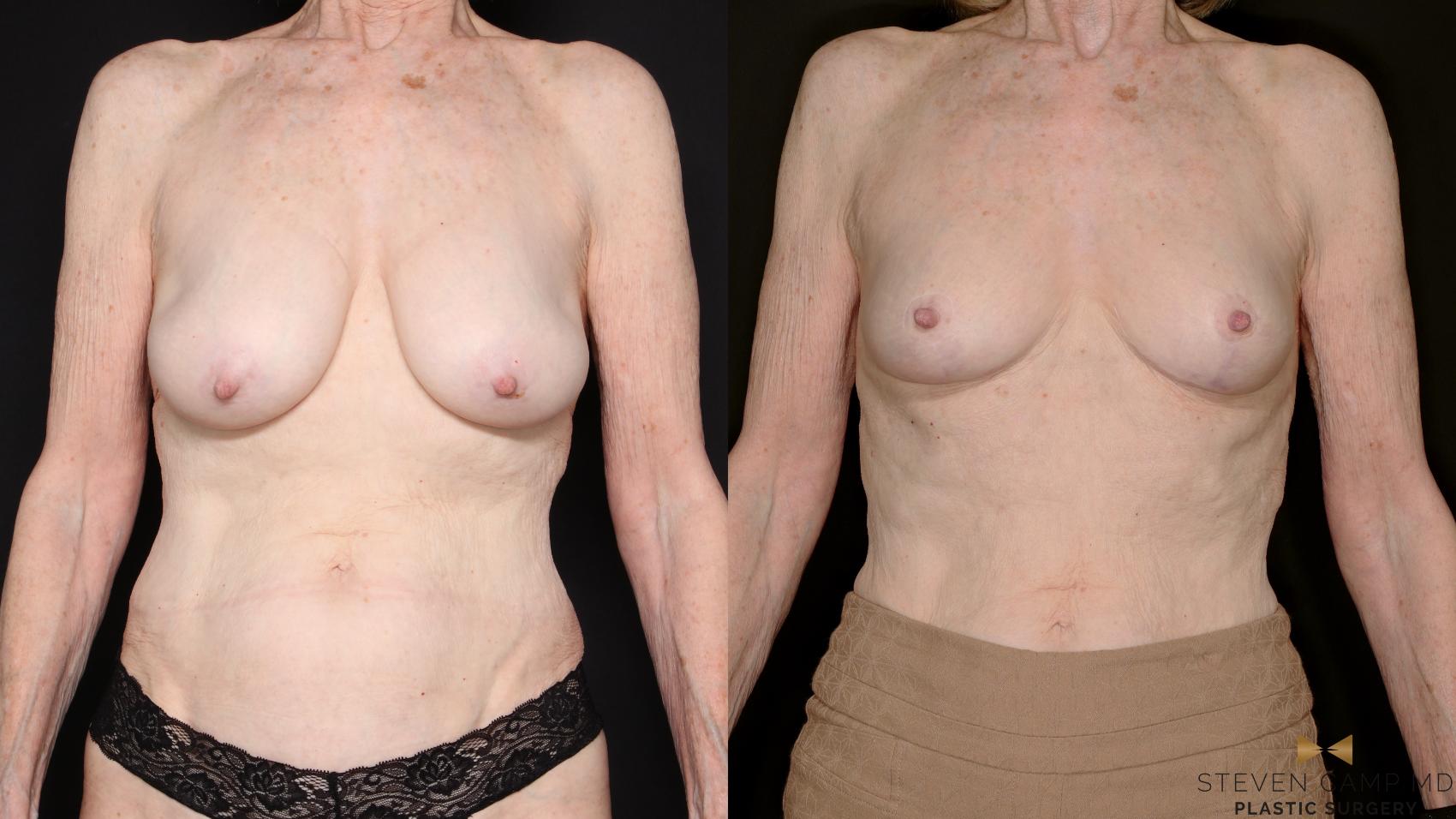 Before & After Breast Lift (Breast Mastopexy - No Implants) Case 760 Front View in Fort Worth & Arlington, Texas