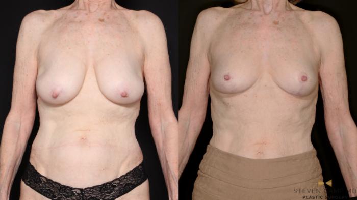 Before & After Breast Lift (Breast Mastopexy - No Implants) Case 760 Front View in Fort Worth & Arlington, Texas