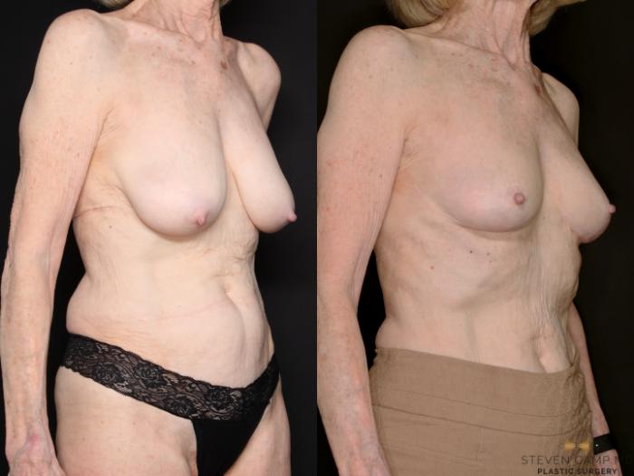 Before & After Breast Lift (Breast Mastopexy - No Implants) Case 760 Right Oblique View in Fort Worth & Arlington, Texas
