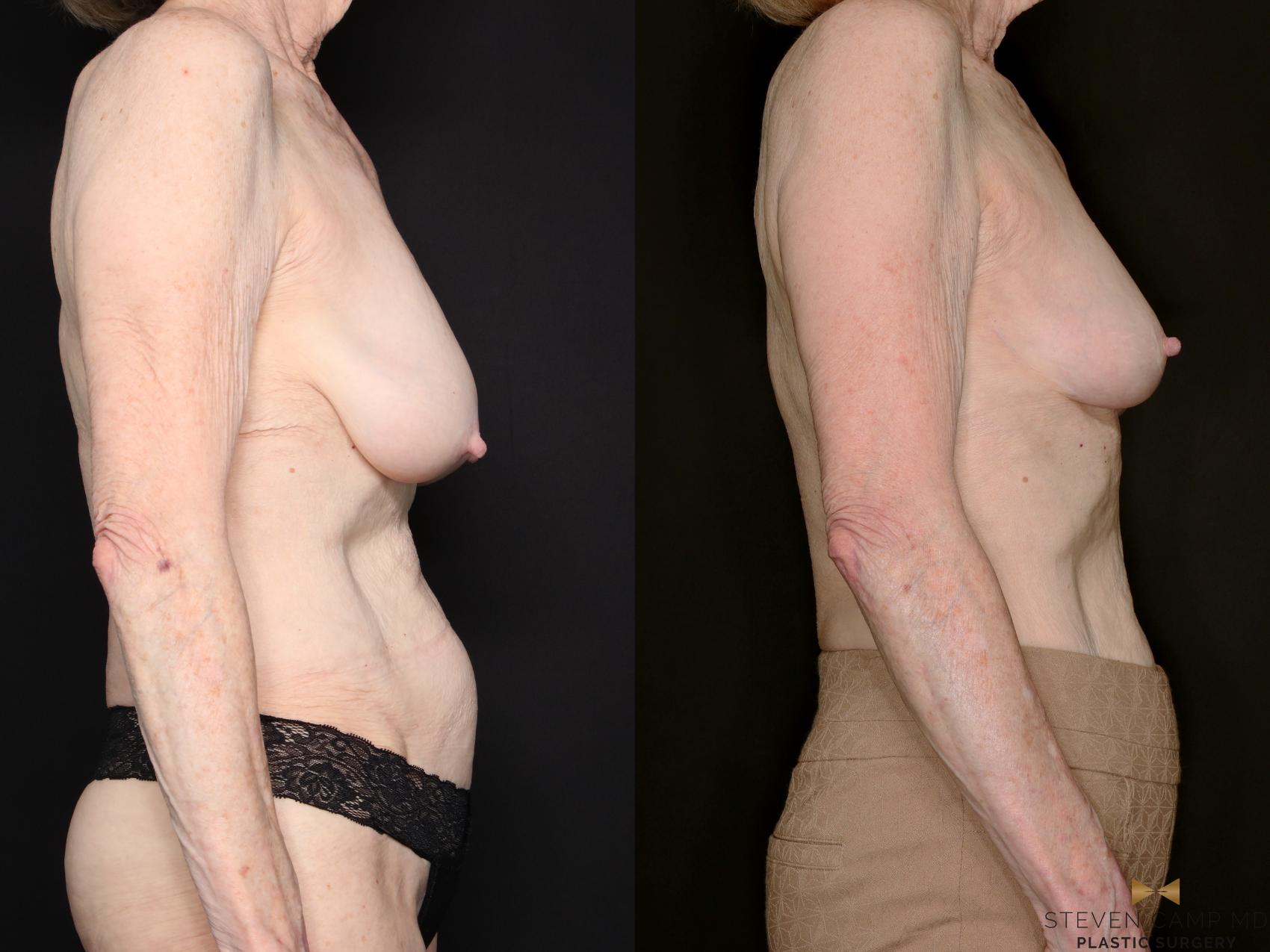 Before & After Breast Lift (Breast Mastopexy - No Implants) Case 760 Right Side View in Fort Worth & Arlington, Texas