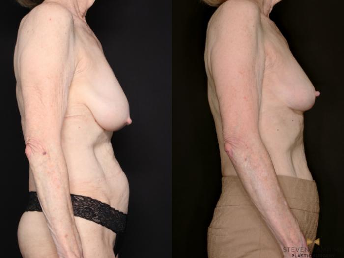 Before & After Breast Lift (Breast Mastopexy - No Implants) Case 760 Right Side View in Fort Worth & Arlington, Texas