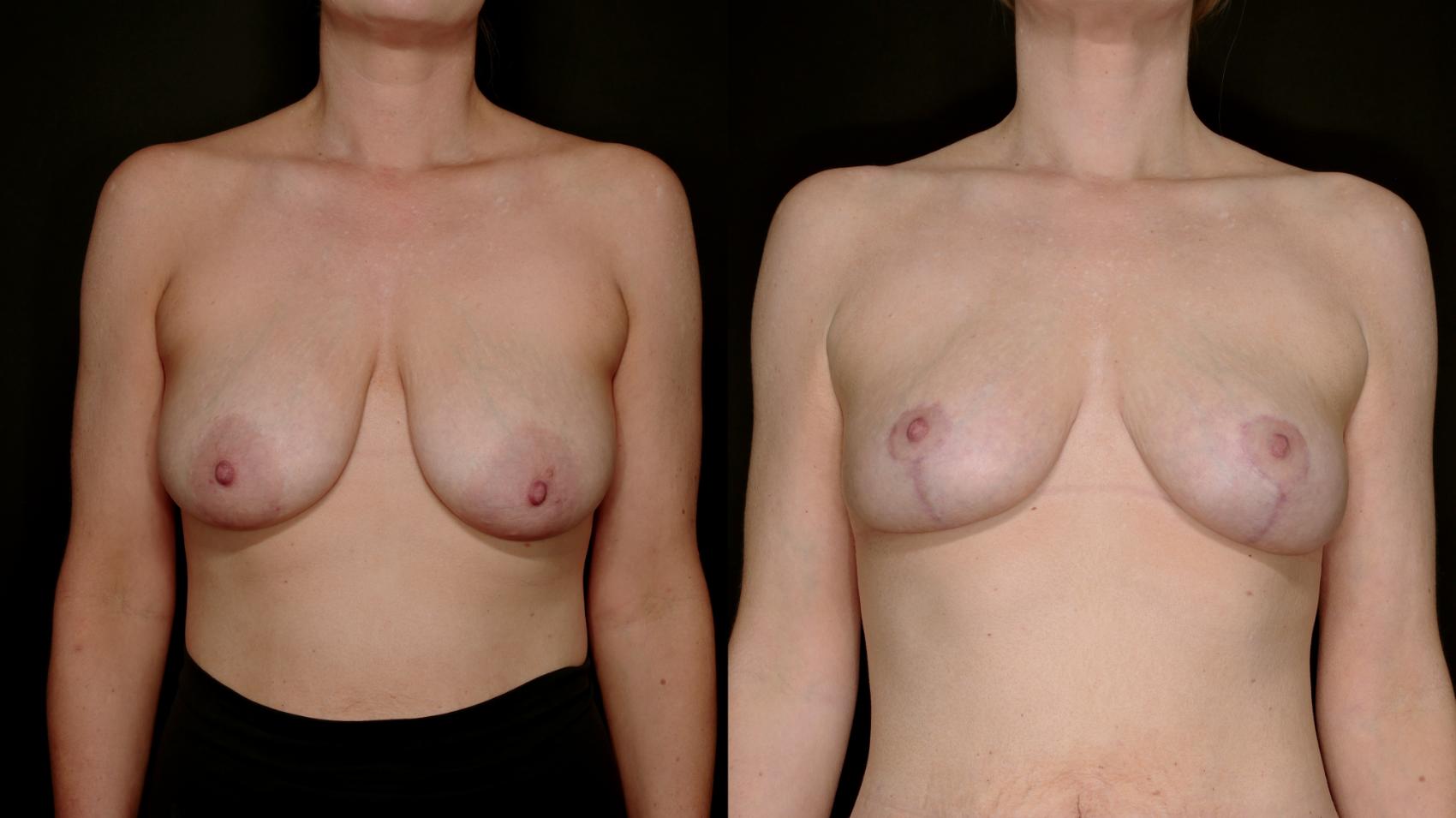Before & After Breast Lift (Breast Mastopexy - No Implants) Case 762 Front View in Fort Worth & Arlington, Texas