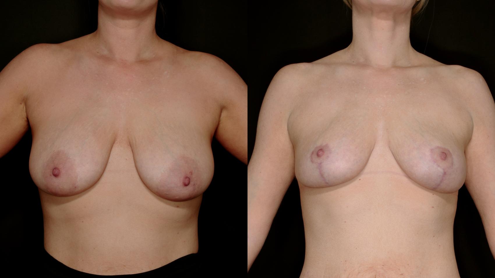 Before & After Breast Lift (Breast Mastopexy - No Implants) Case 762 Frontal Arms Up  View in Fort Worth & Arlington, Texas