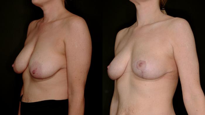Before & After Breast Lift (Breast Mastopexy - No Implants) Case 762 Left Oblique View in Fort Worth & Arlington, Texas