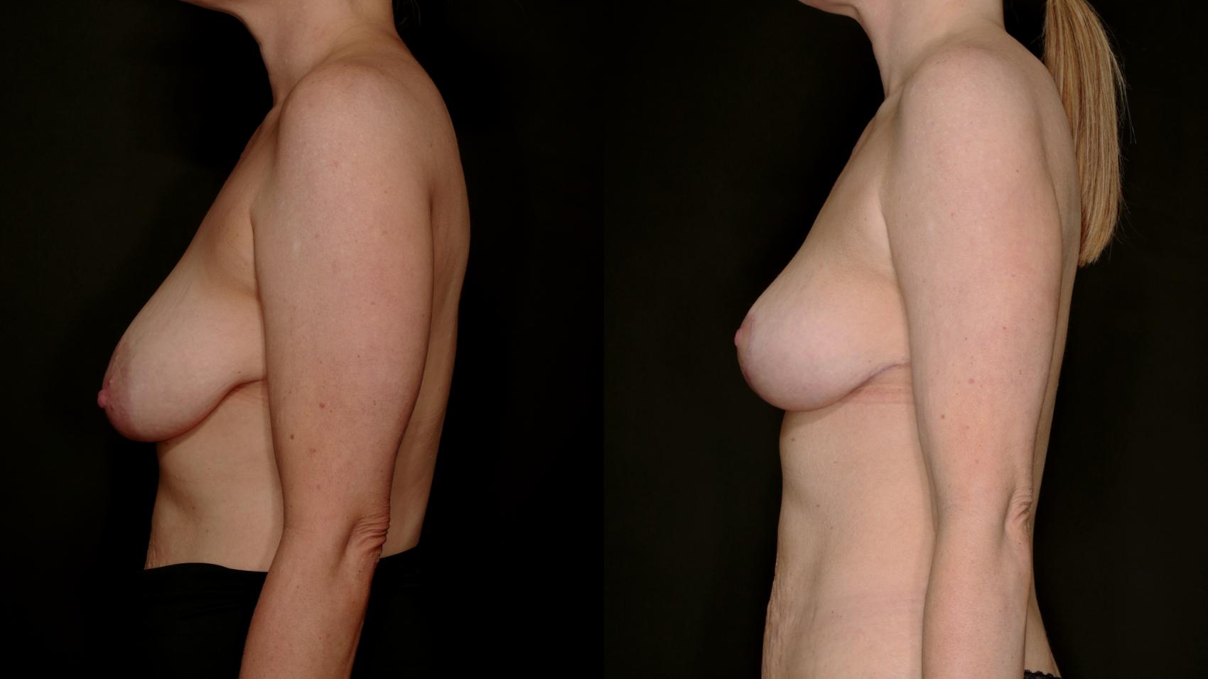 Before & After Breast Lift (Breast Mastopexy - No Implants) Case 762 Left Side View in Fort Worth & Arlington, Texas