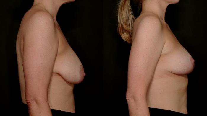 Before & After Breast Lift (Breast Mastopexy - No Implants) Case 762 Right Side View in Fort Worth & Arlington, Texas