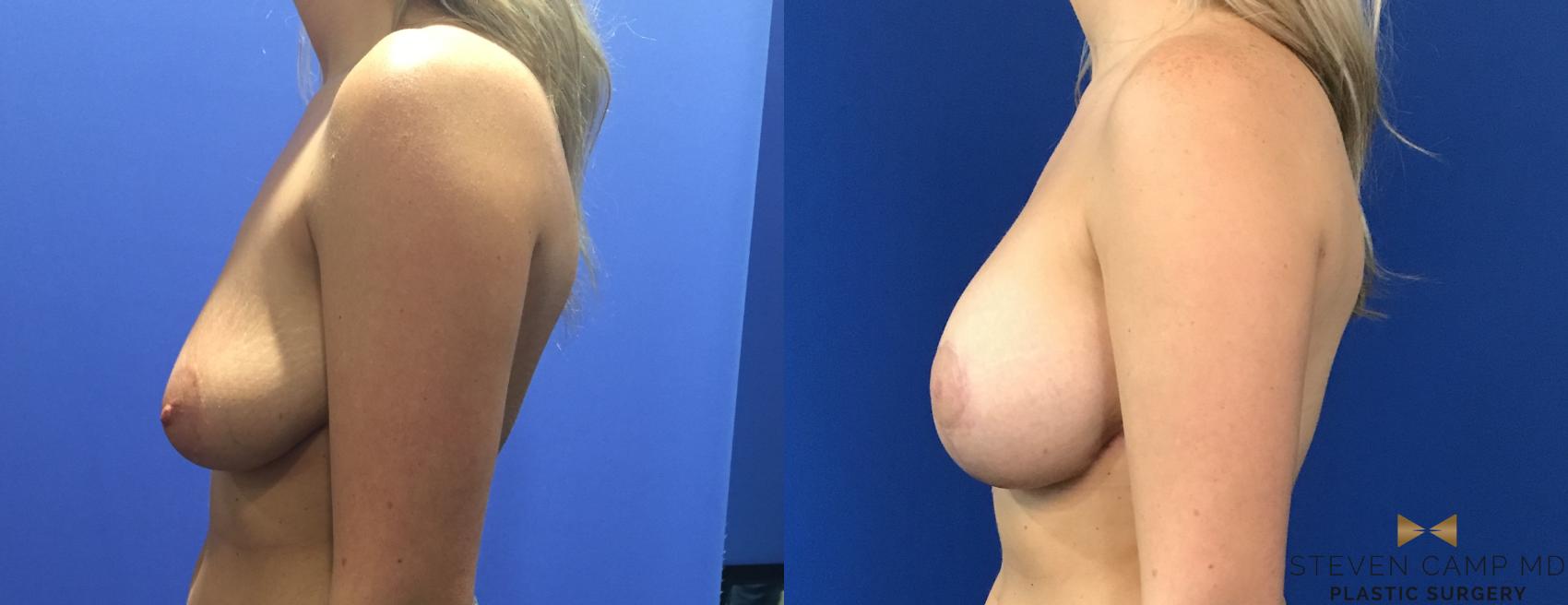 Before & After Breast Lift (Breast Mastopexy with Implants) Case 120 View #2 View in Fort Worth & Arlington, Texas