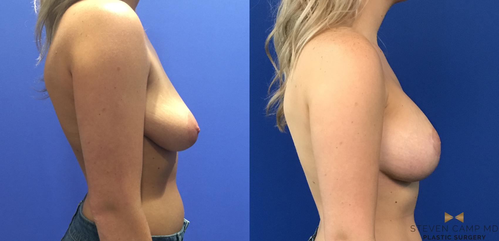 Before & After Breast Lift (Breast Mastopexy with Implants) Case 120 View #4 View in Fort Worth & Arlington, Texas