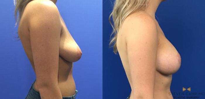 Before & After Breast Lift (Breast Mastopexy with Implants) Case 120 View #4 View in Fort Worth & Arlington, Texas