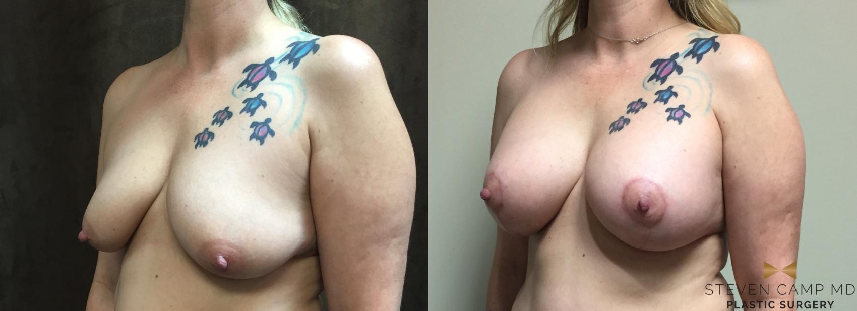 Before & After Breast Lift (Breast Mastopexy with Implants) Case 121 View #2 View in Fort Worth & Arlington, Texas