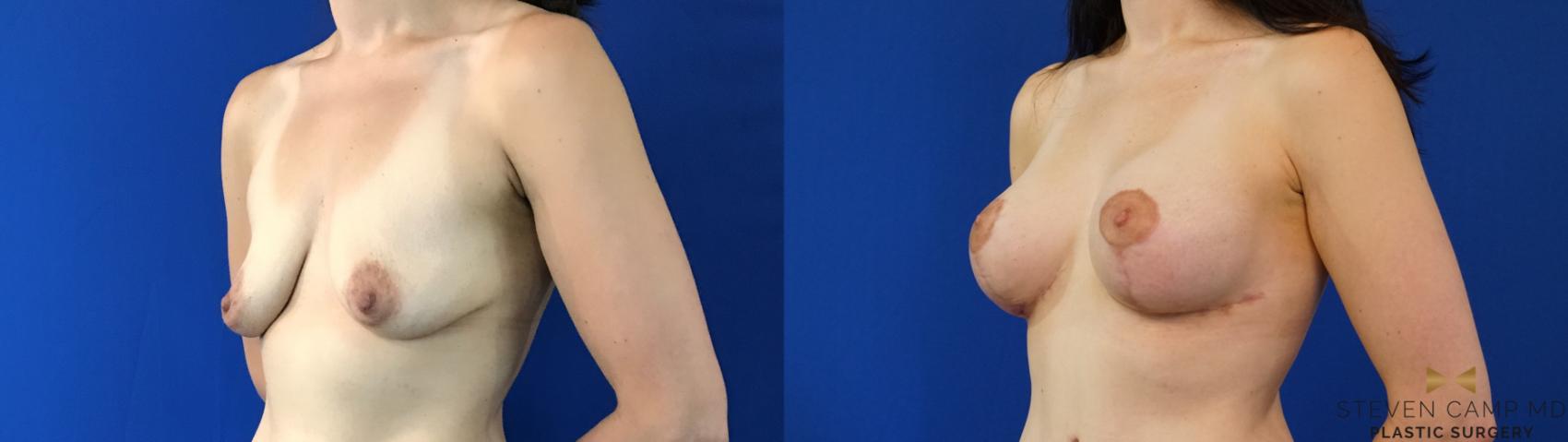 Before & After Breast Lift (Breast Mastopexy with Implants) Case 132 View #2 View in Fort Worth & Arlington, Texas