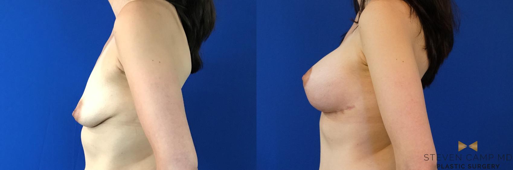 Before & After Breast Lift (Breast Mastopexy with Implants) Case 132 View #3 View in Fort Worth & Arlington, Texas