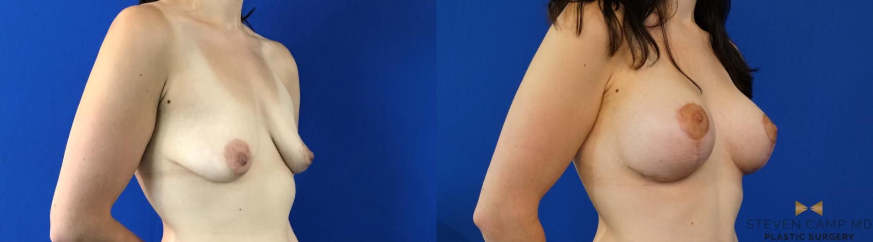 Before & After Breast Lift (Breast Mastopexy with Implants) Case 132 View #4 View in Fort Worth & Arlington, Texas