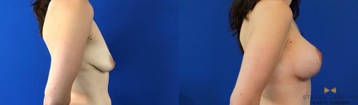 Before & After Breast Lift (Breast Mastopexy with Implants) Case 132 View #5 View in Fort Worth & Arlington, Texas