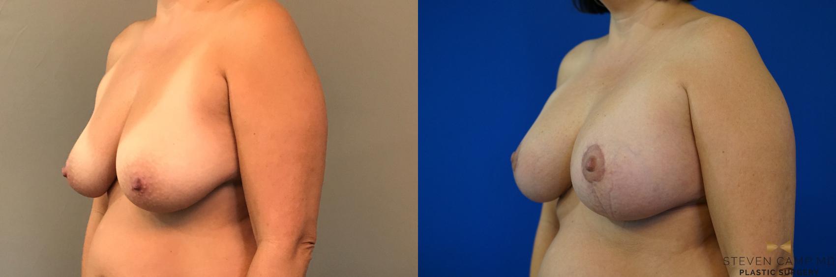 Before & After Breast Lift (Breast Mastopexy with Implants) Case 134 View #1 View in Fort Worth & Arlington, Texas