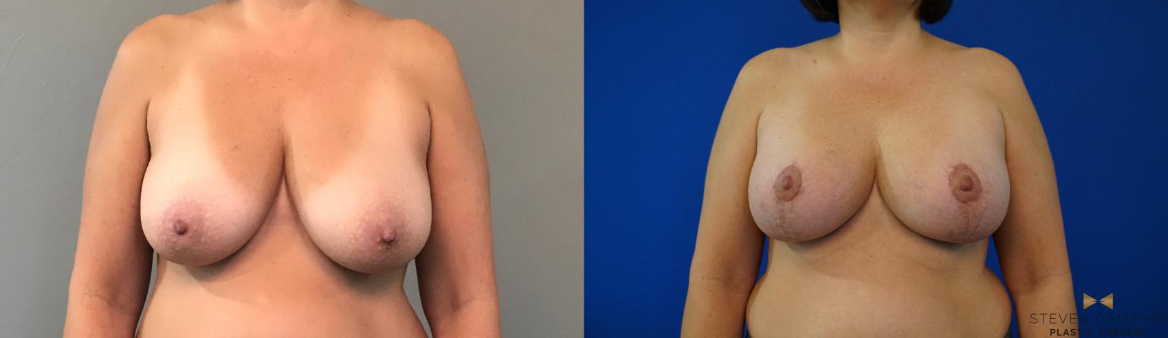 Before & After Breast Lift (Breast Mastopexy with Implants) Case 134 View #2 View in Fort Worth & Arlington, Texas