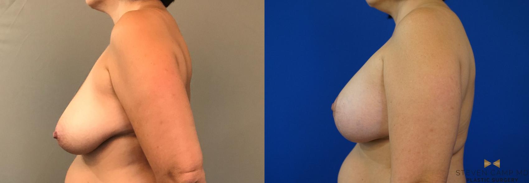 Before & After Breast Lift (Breast Mastopexy with Implants) Case 134 View #3 View in Fort Worth & Arlington, Texas