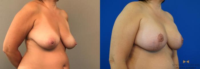 Before & After Breast Lift (Breast Mastopexy with Implants) Case 134 View #4 View in Fort Worth & Arlington, Texas