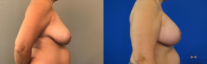Before & After Breast Lift (Breast Mastopexy with Implants) Case 134 View #5 View in Fort Worth & Arlington, Texas
