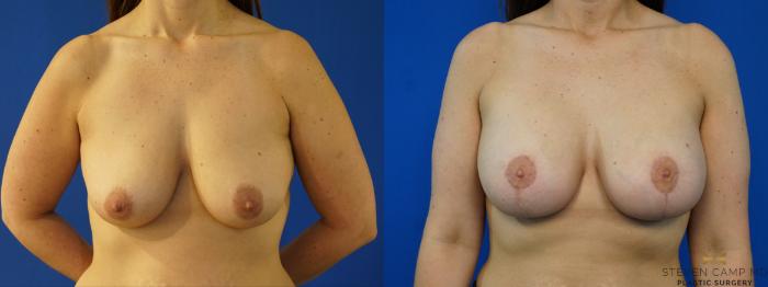 Before & After Breast Lift (Breast Mastopexy with Implants) Case 165 View #1 View in Fort Worth & Arlington, Texas