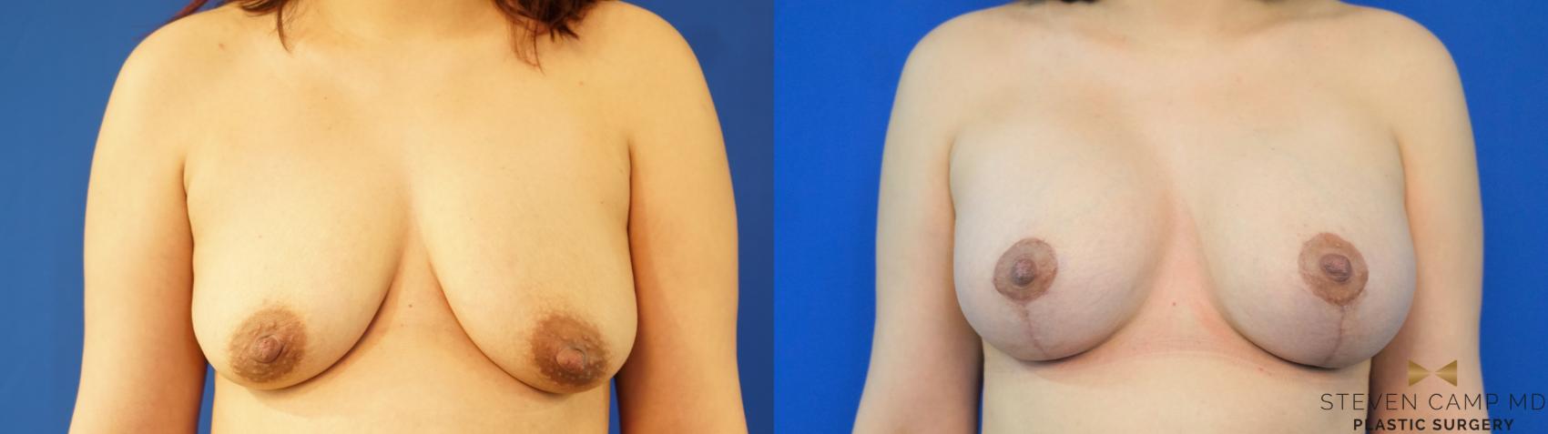 Before & After Breast Lift (Breast Mastopexy with Implants) Case 168 View #2 View in Fort Worth & Arlington, Texas