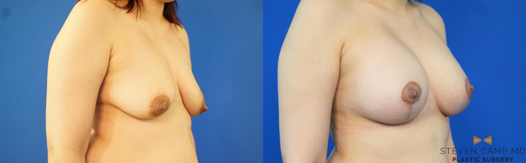 Before & After Breast Lift (Breast Mastopexy with Implants) Case 168 View #5 View in Fort Worth & Arlington, Texas
