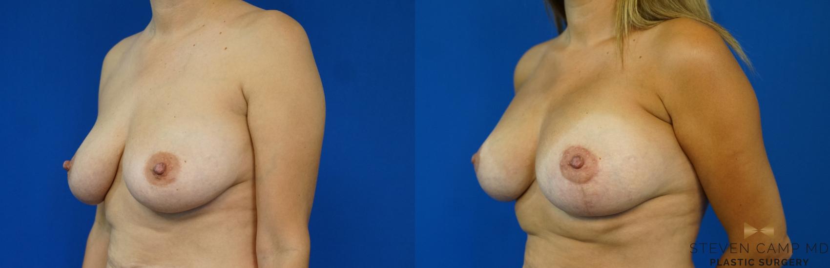 Before & After Breast Lift (Breast Mastopexy with Implants) Case 169 View #1 View in Fort Worth & Arlington, Texas