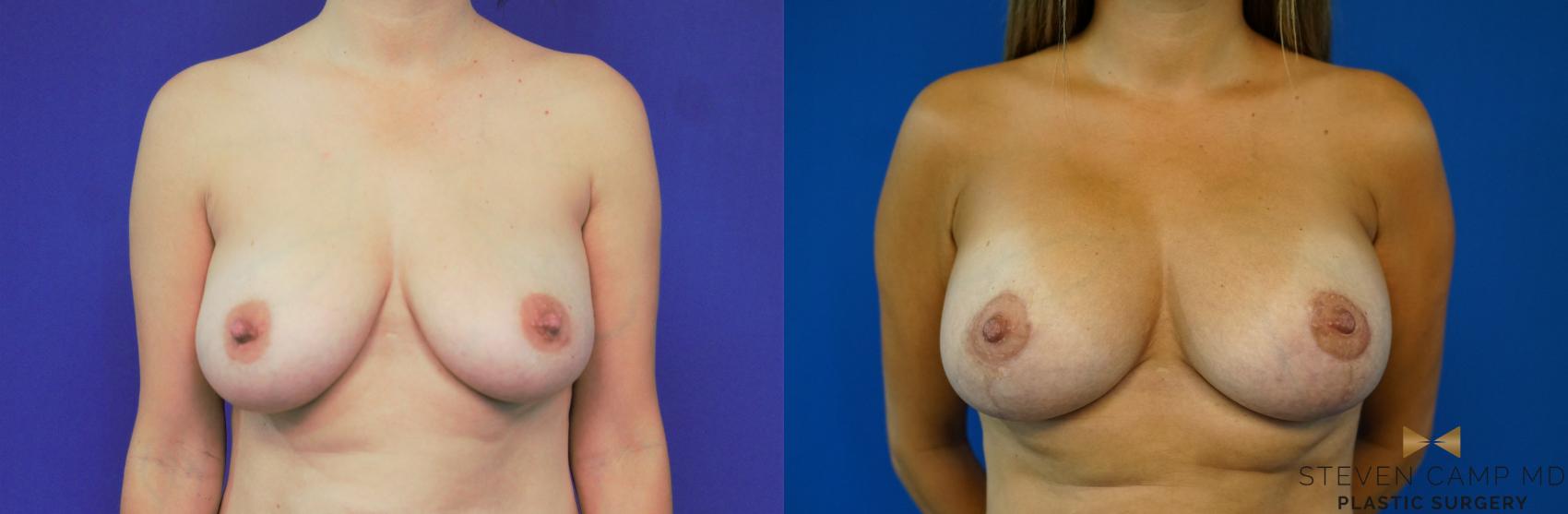 Before & After Breast Lift (Breast Mastopexy with Implants) Case 169 View #2 View in Fort Worth & Arlington, Texas