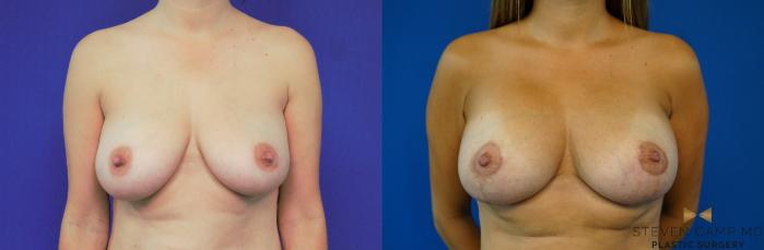 Before & After Breast Lift (Breast Mastopexy with Implants) Case 169 View #2 View in Fort Worth & Arlington, Texas